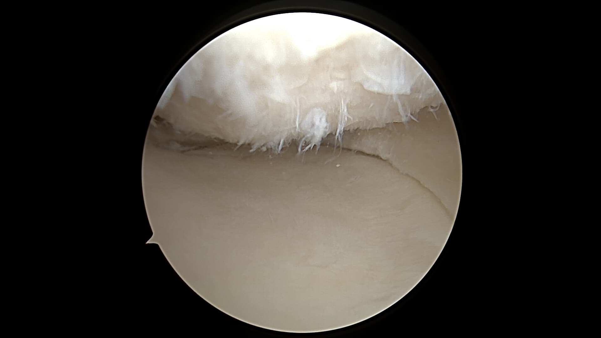 Méniscectomie arthroscopique — vue 2