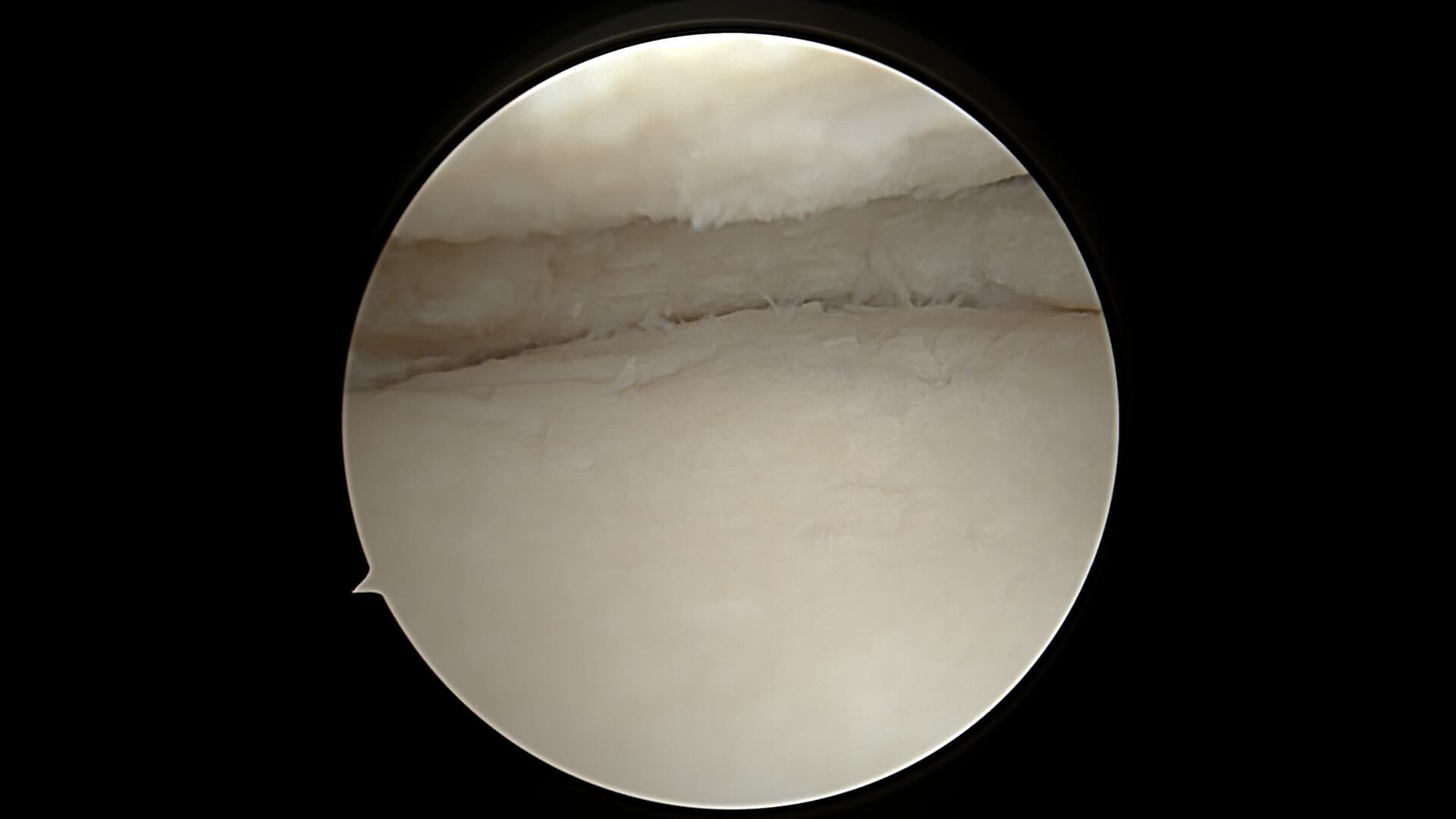 Méniscectomie arthroscopique — vue per-opératoire