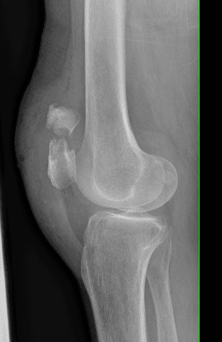 Radiographie d'une fracture de rotule — indication de l'ostéosynthèse