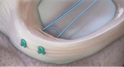 Suture méniscale — vue 2