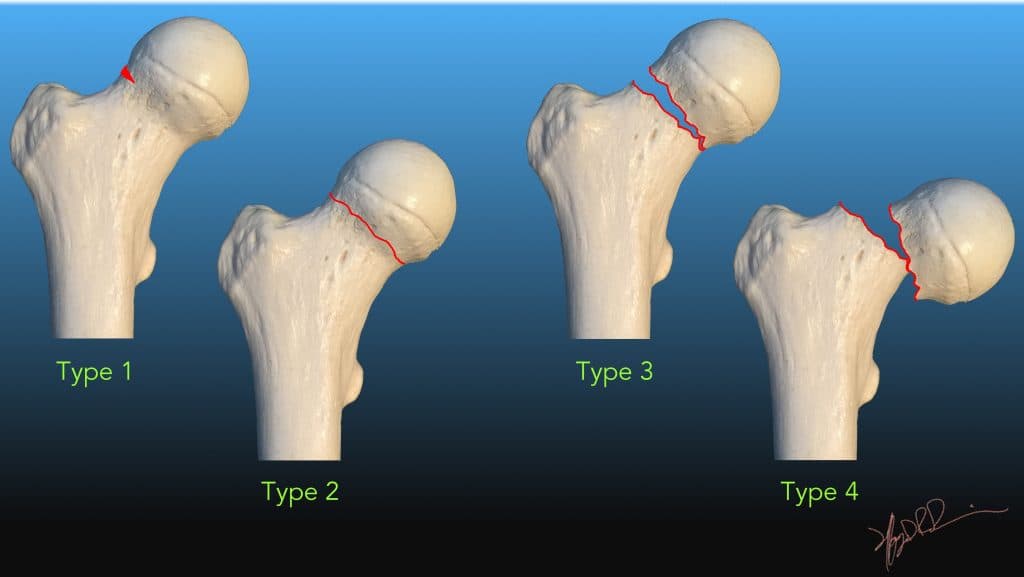 Classification de Garden des fractures du col fémoral — du stade I au stade IV