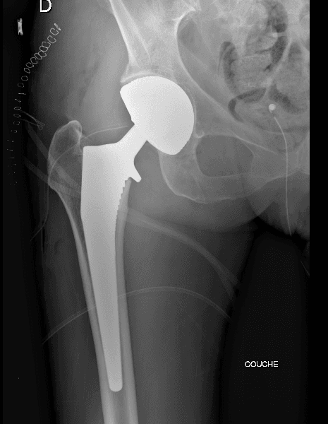 Radiographie post-opératoire d'une prothèse totale de hanche