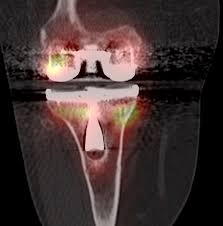 SPECT-CT complémentaire d'une prothèse de genou douloureuse