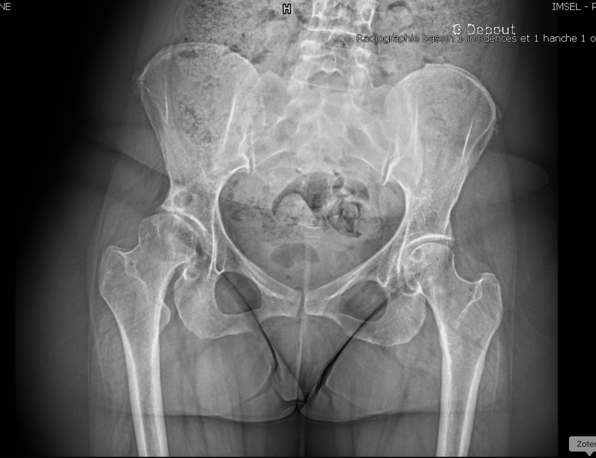 Radiographie de profil d'arthrose sur dysplasie de hanche