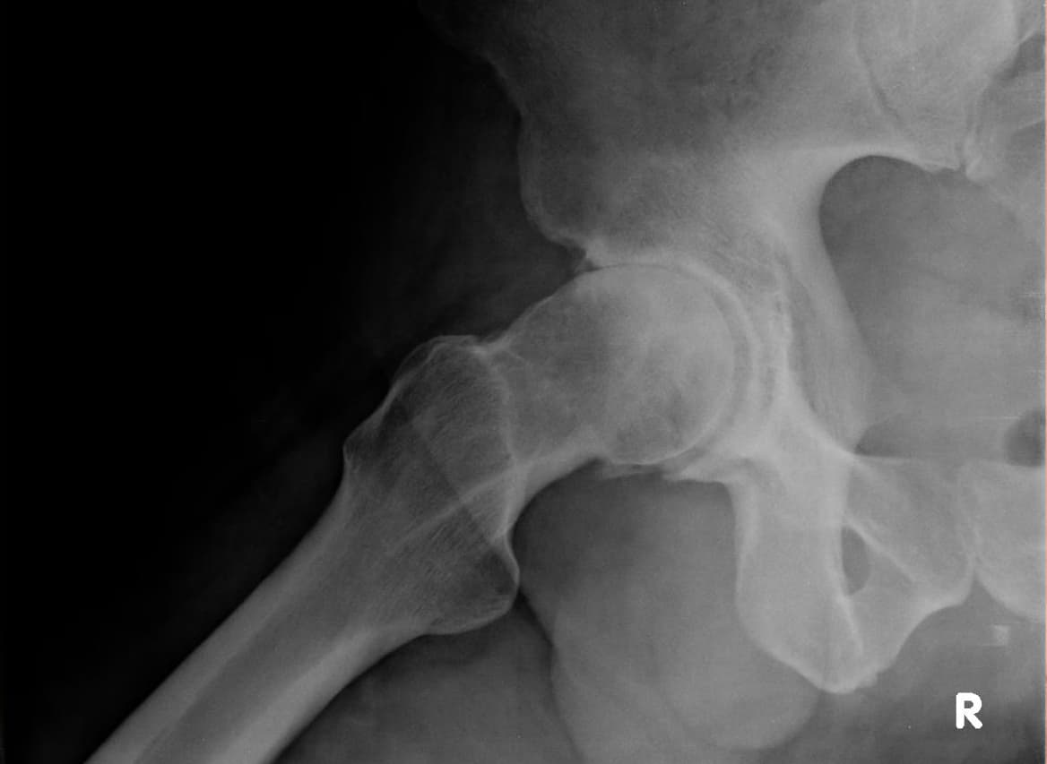 Radiographie de hanche coxarthrosique de face
