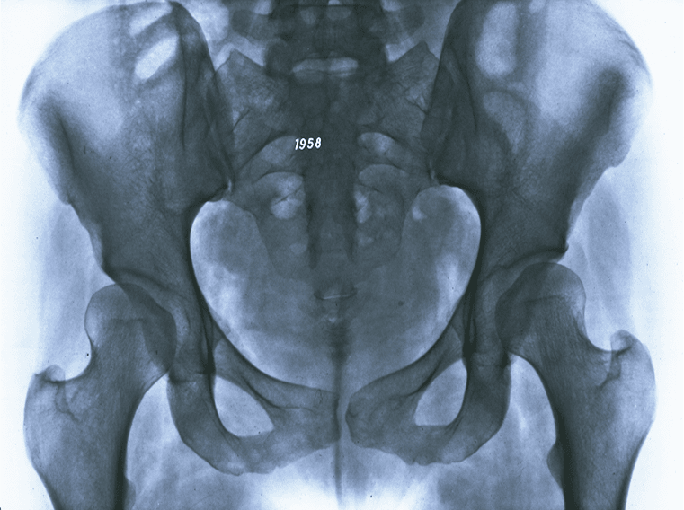 Radiographie de dysplasie de hanche de face