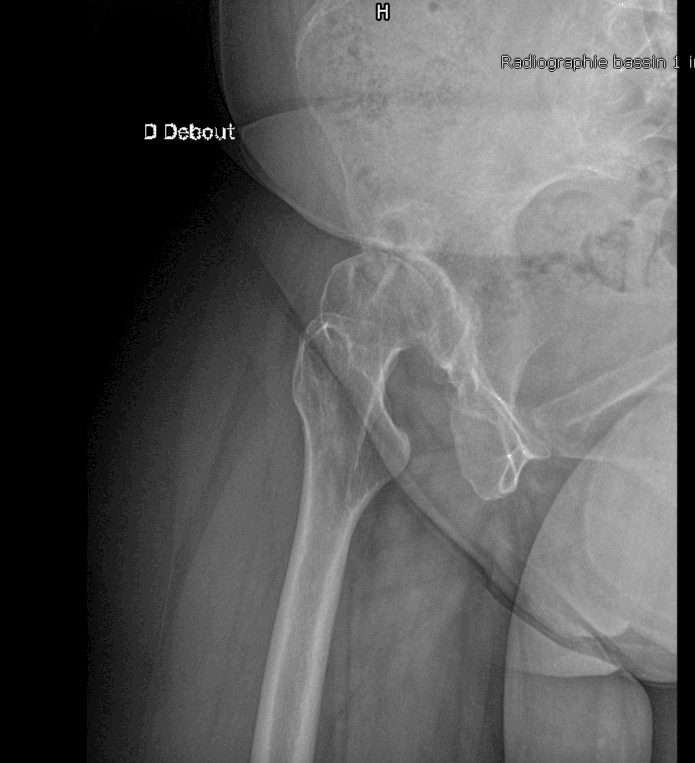 Radiographie de profil d'une dysplasie de hanche