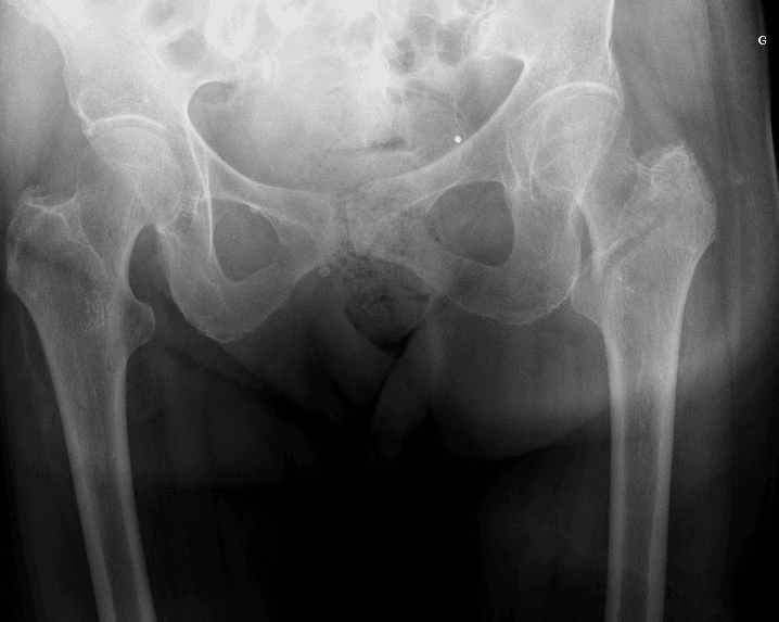 Radiographie de fracture pertrochantérienne, vue 3