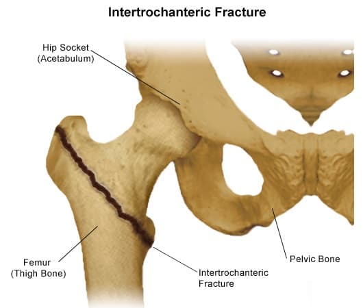Schéma anatomique d'une fracture pertrochantérienne