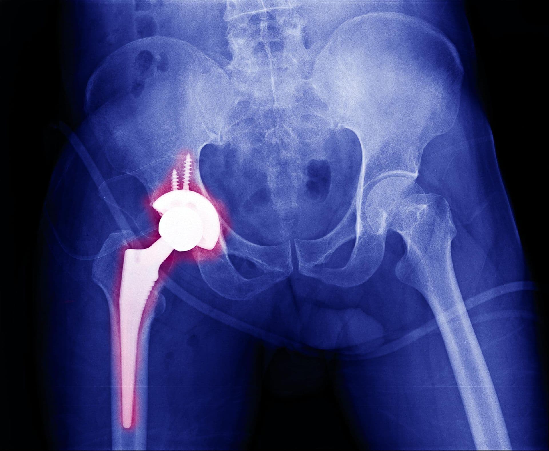 Radiographie de prothèse totale de hanche douloureuse